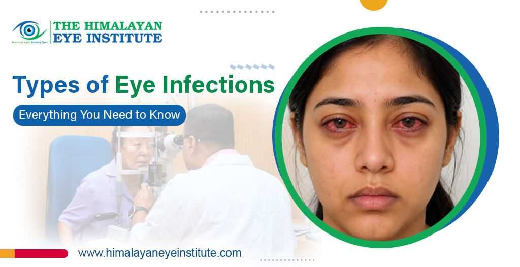 Types of Eye Infections