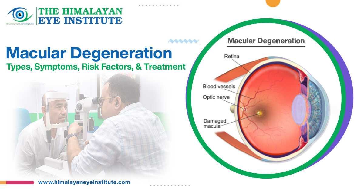 Macular Degeneration
