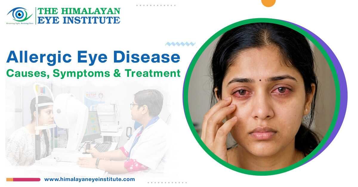 Allergic Eye Disease
